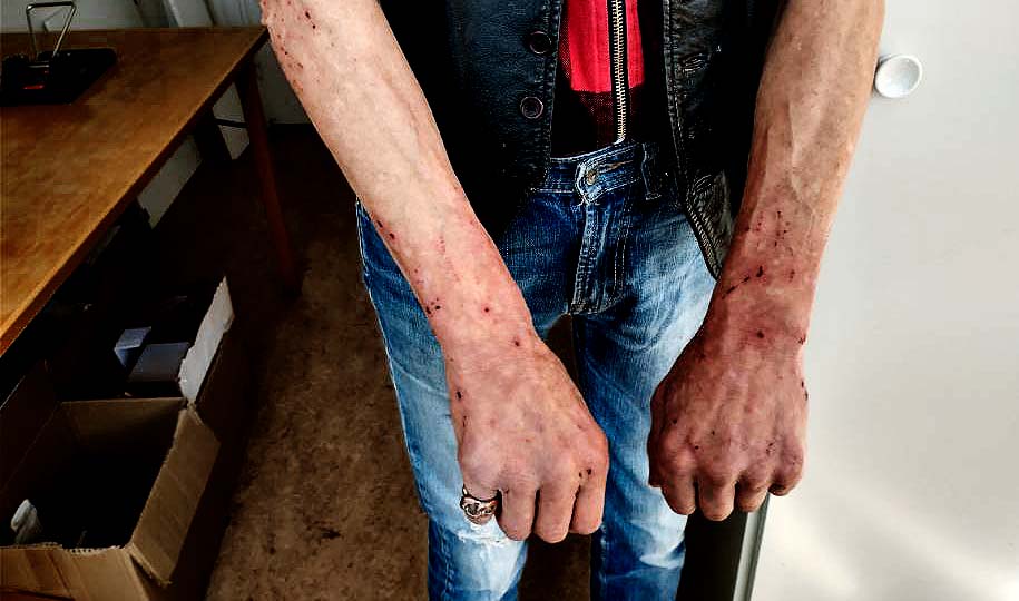 Vägglöss bet G över hela kroppen