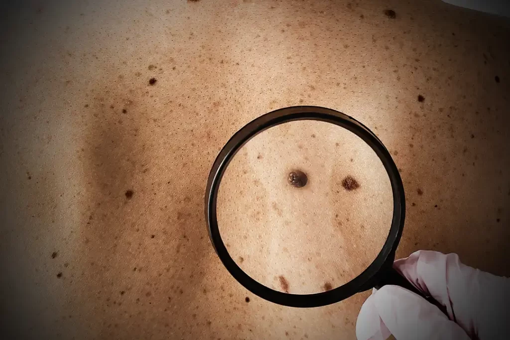 Leverfläck visas med ett förstorings glas på en patients rygg